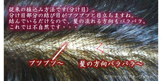 かつらの髪　一般的な植え方