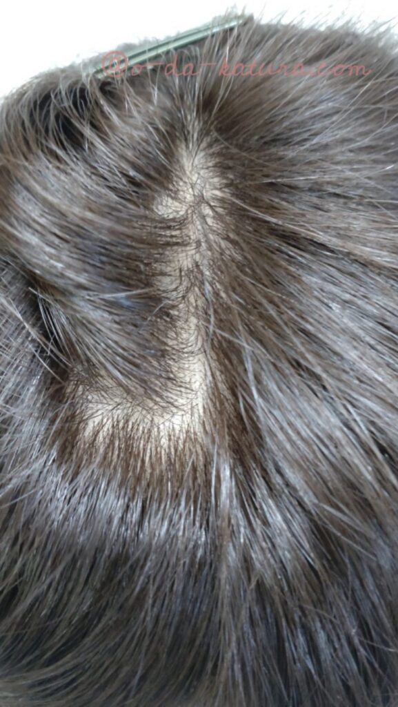 50年前の自毛ヘアピースをリフォームした部分ウィッグの分け目つむじ