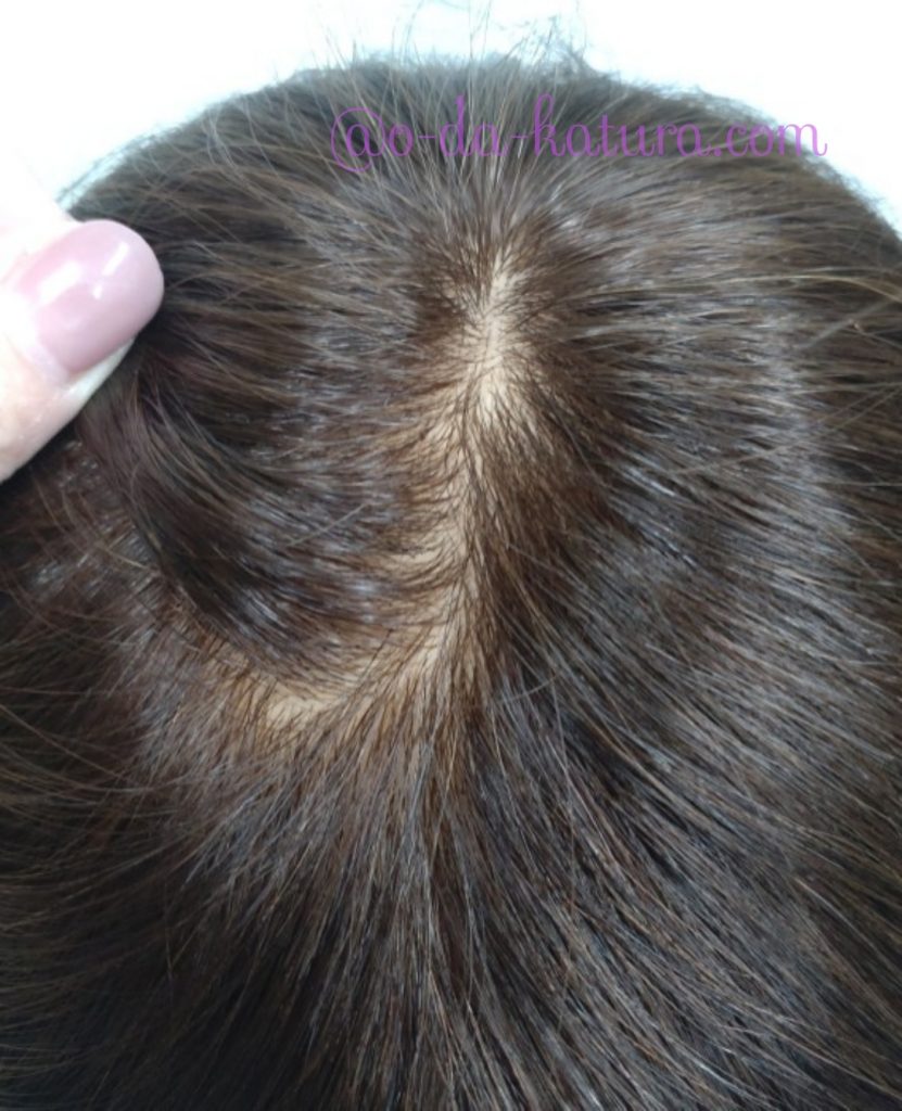 ご本人の自毛約25cmと工房の人毛をブレンドして作ったロングヘアの医療用ウィッグの頭頂部