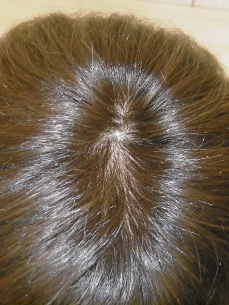 30年前に作った奥さんの地毛のヘアピースの髪で旦那さんの医療用ウィッグを上から見たところ