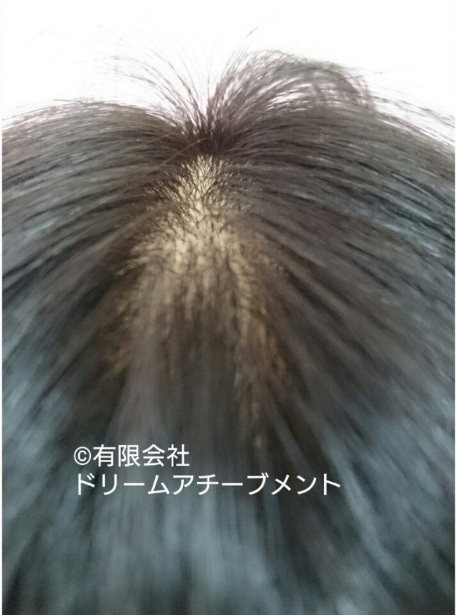 ご本人の自毛約30〜40cmを使いレイヤーを入れて長めに仕上げた医療用ウィッグを上からみたところ