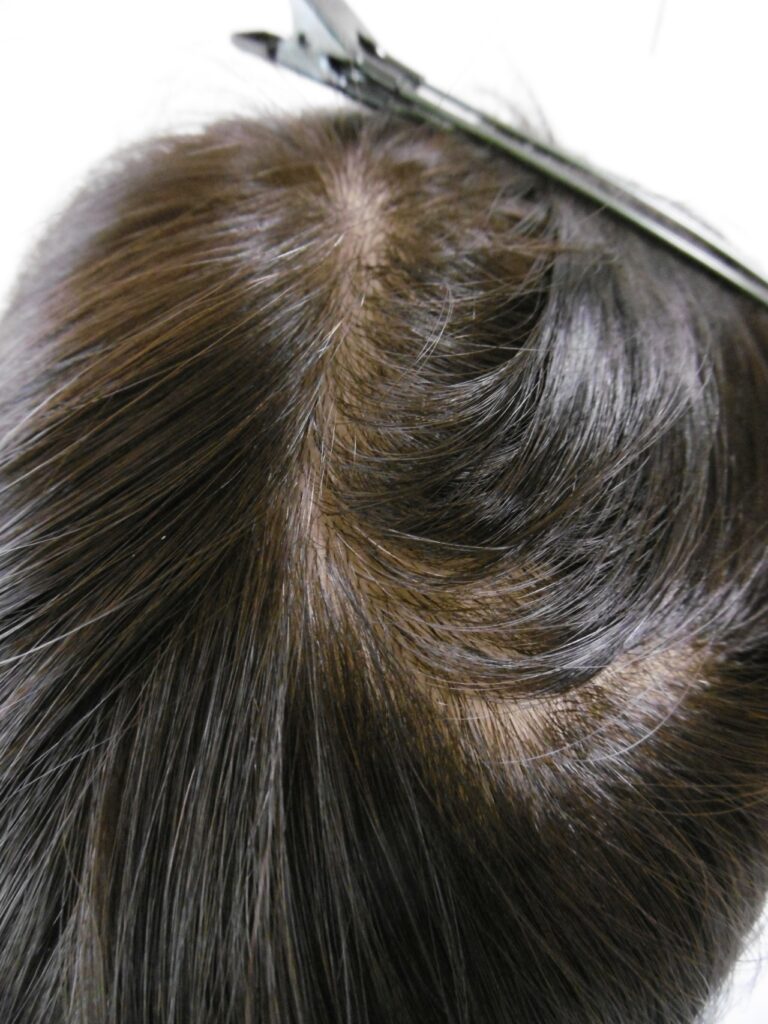 ご本人の自毛約35cmで作ったサラサラのセミロング医療用ウィッグの頭頂部