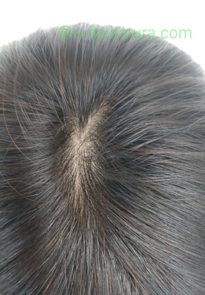 自毛で作った部分ウィッグの分け目