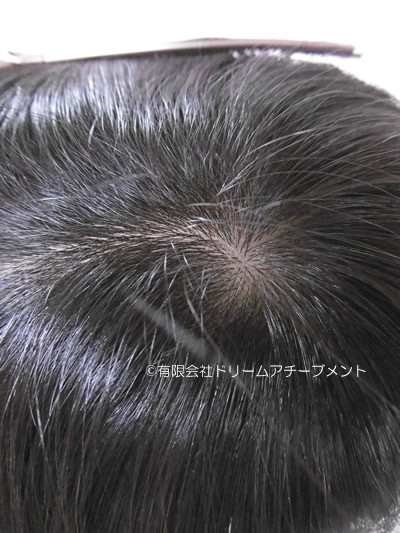 白髪を除いた自毛のトップピース 頭頂部